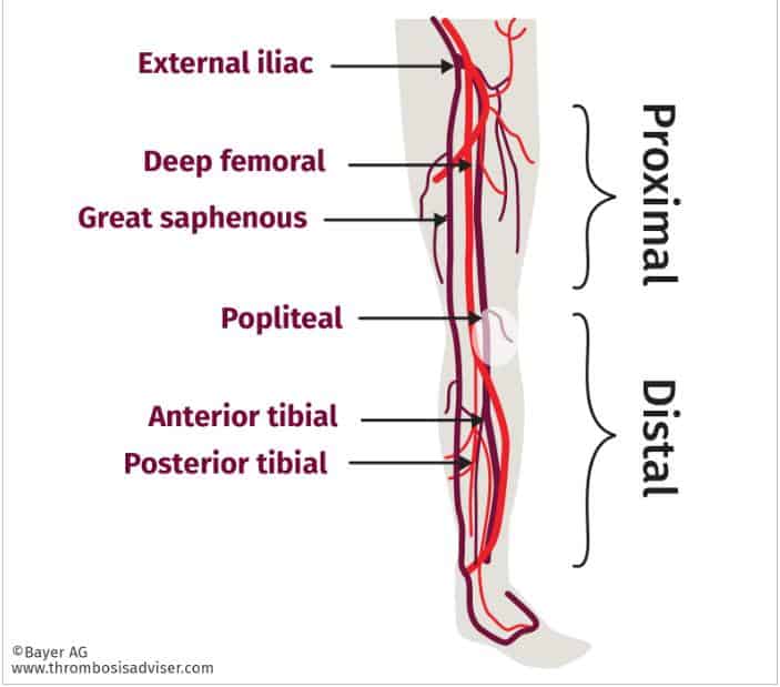 leg swelling treatment