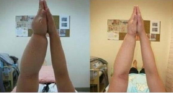 leg swelling treatment