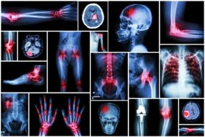 exercise xray inflammation