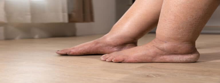 how intermittent pneumatic compression devices help prevent swelling and pain